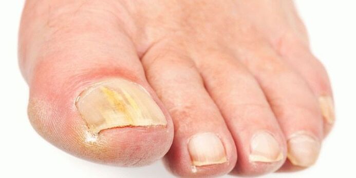 Wirksame Produkte aus dem Nagelpilz