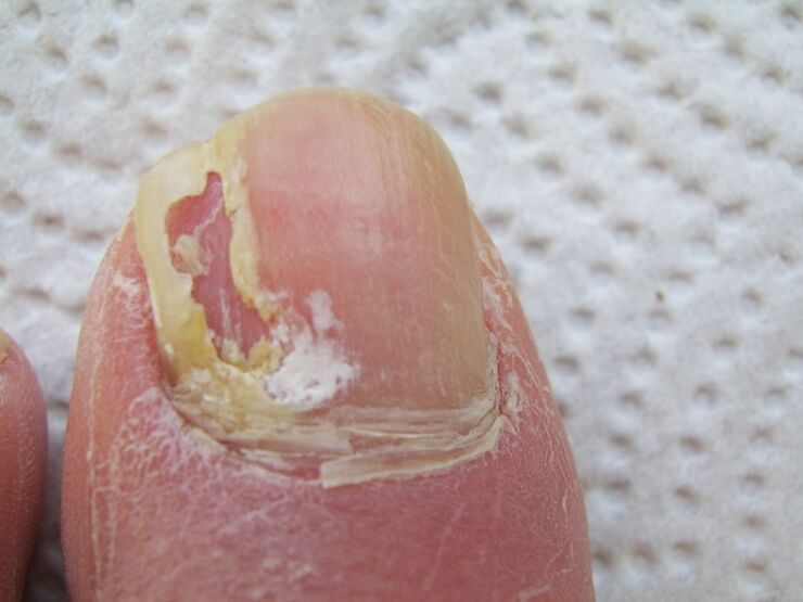 Bei der Onychomykose kommt es zu einer Verformung der Nagelplatte