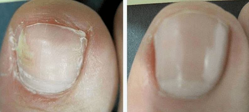 Nagel vor und nach der Pilzbehandlung