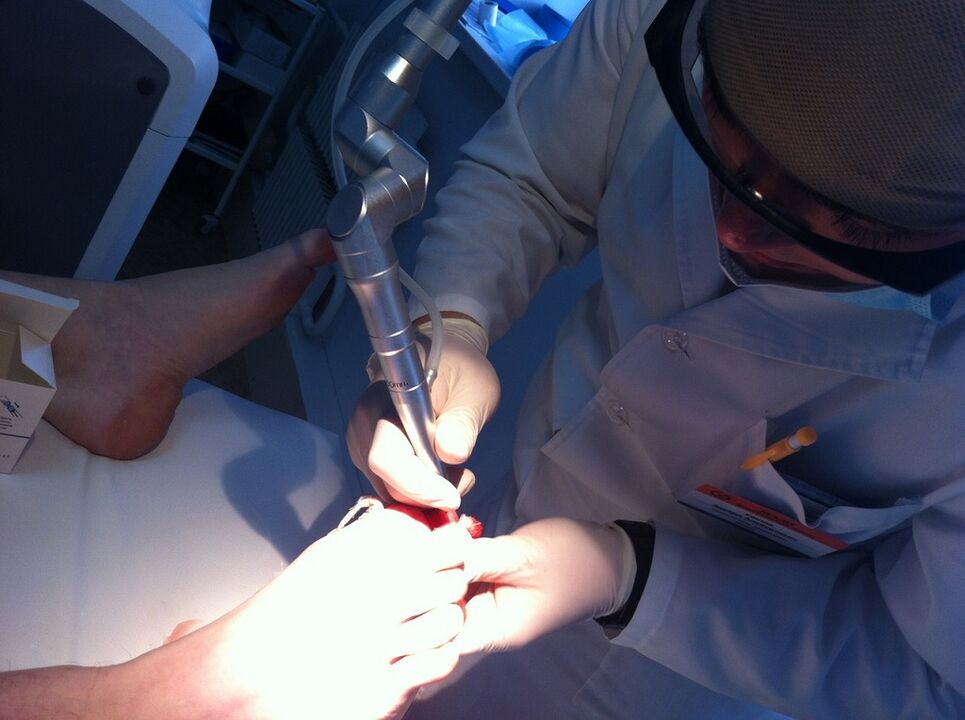 Mykose Laserbehandlung
